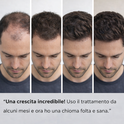 Hairboost® Sistema di Micro-Infusione Capillare per Favorire la Ricrescita dei Capelli